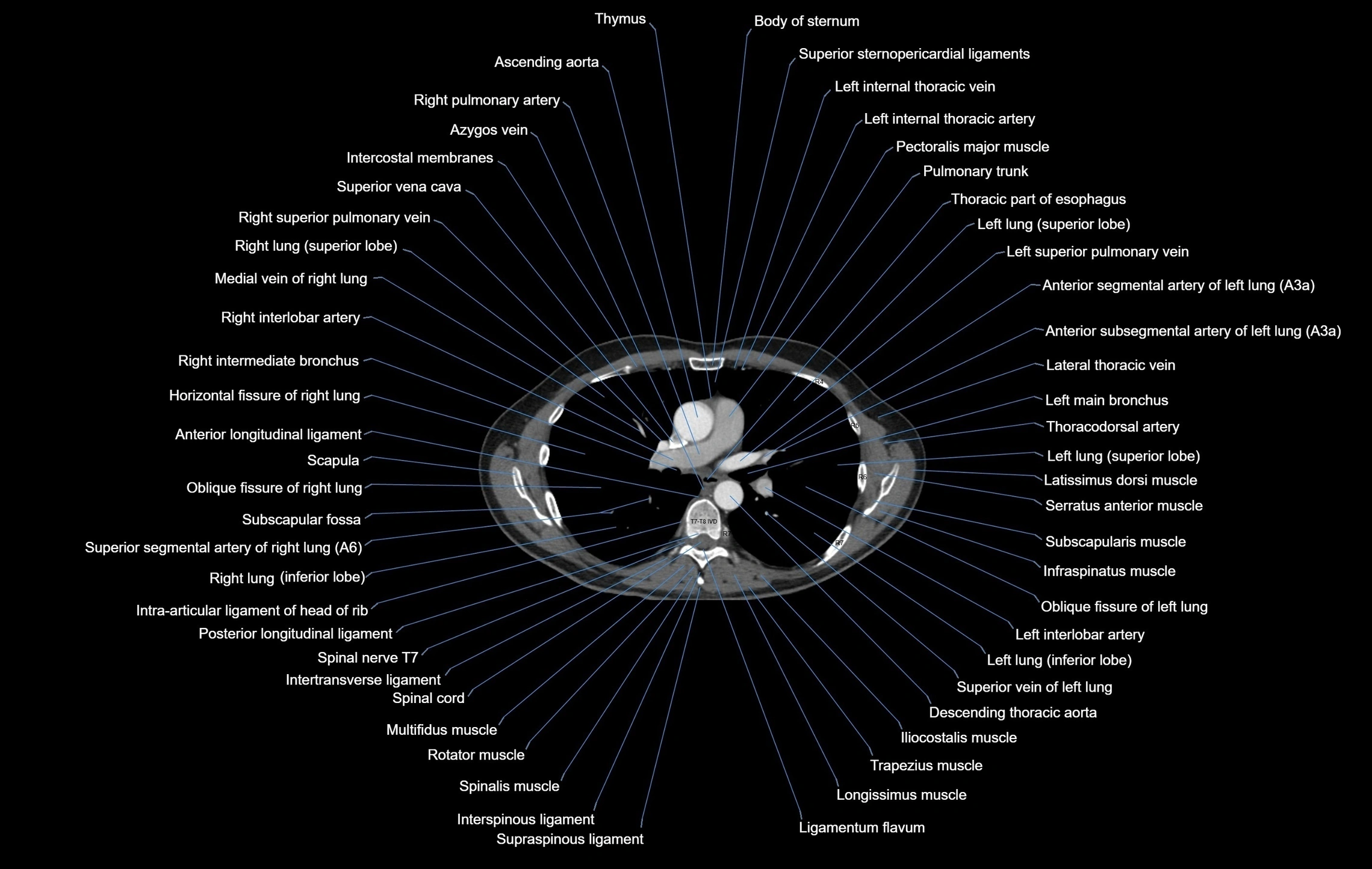 CT chest (thorax) soft tissue window labelled axial cross sectional anatomy radiology image-00058.webp